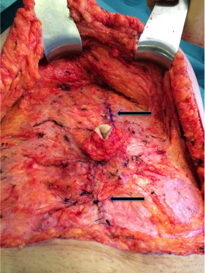 3. Nueva pared abdominal funcional