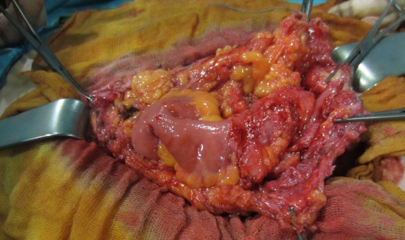 Fistula intestinal