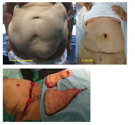 Testimonio Abdominoplastia