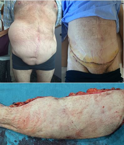 abdominoplastia