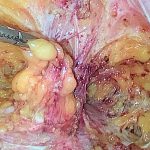 5. Hernia umbilical